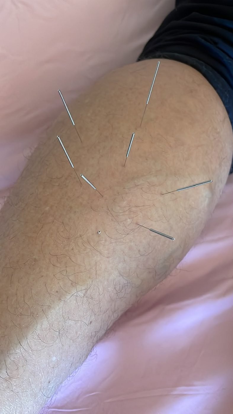 Sessão de acupuntura